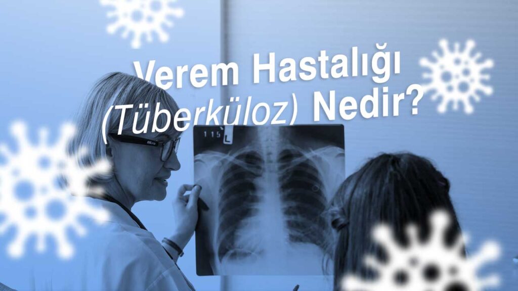 Verem Hastal (Tberkloz) Nedir?